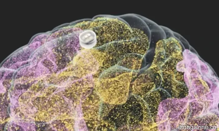 This small brain implant has the potential to alleviate depression from home.